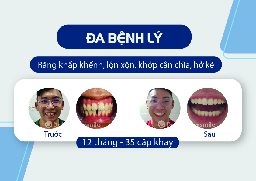 Khách hàng trước và sau khi niềng răng tại dr.wondersmile-51