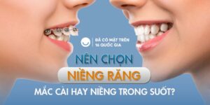 Nên chọn niềng răng mắc cài hay niềng răng trong suốt?