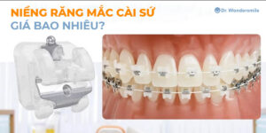 Niềng răng mắc cài sứ trong suốt giá bao nhiêu?