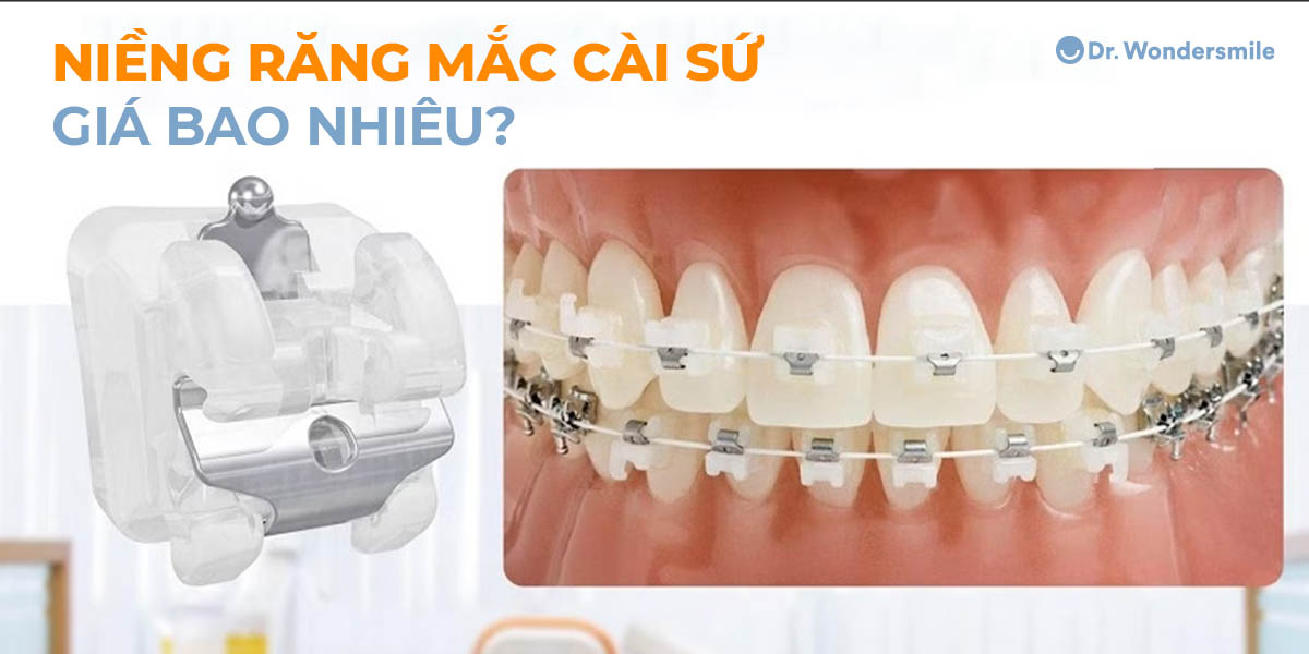 Niềng răng mắc cài sứ trong suốt giá bao nhiêu?