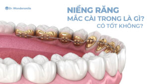 Niềng răng mắc cài trong là gì? Có tốt không?