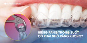 Niềng răng trong suốt có phải nhổ răng không?