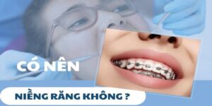 có nên niềng răng không