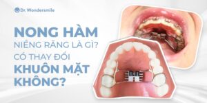 Nong hàm niềng răng là gì? Có thay đổi khuôn mặt không?