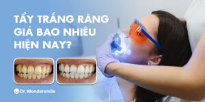 Tẩy trắng răng giá bao nhiêu hiện nay? Có tốt không?