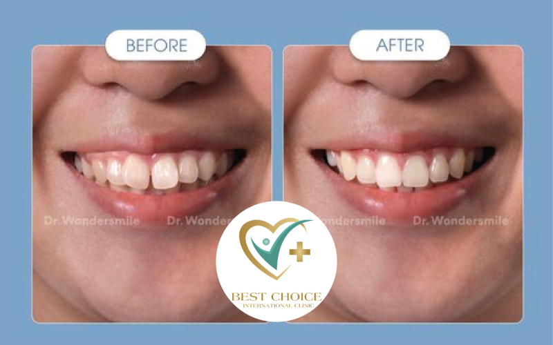 Niềng răng trong suốt tại Hà Nội